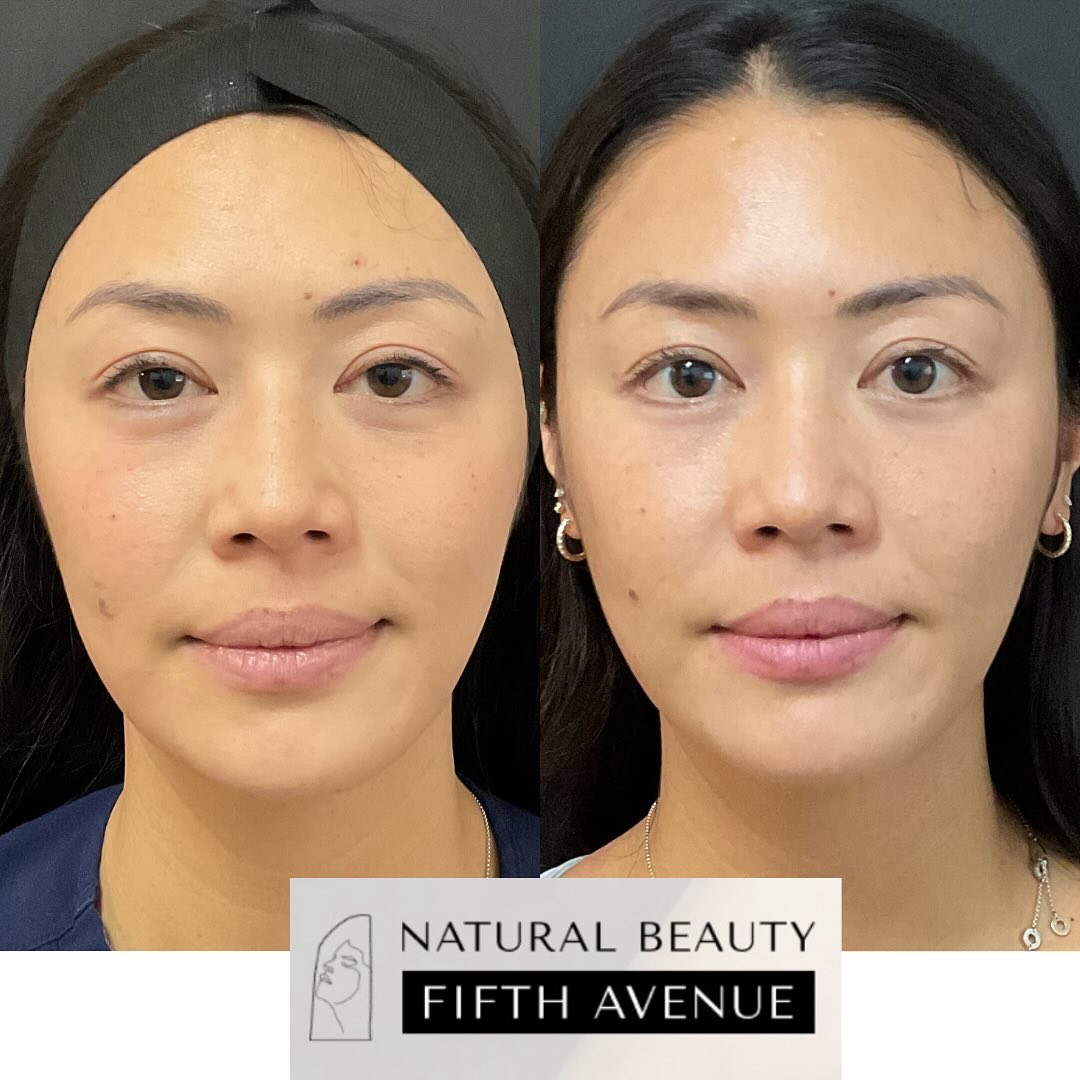 Before and after RF microneedling treatment showing improved skin texture and radiance